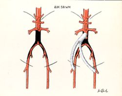 Bypass -- Aortic Graft to Both Iliac Arteries