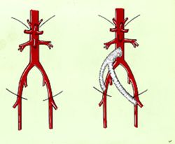 Bypass -- Replacement Graft below Renal Arteries to Both Iliac Arteries withou Necrosis
