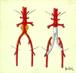 Bypass with Aneurysm -- Aortic Aneurysm Repair with Graft to Both Iliac Arteries
