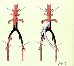 Bypass -- Replacement Graft below Renal Arteries to Both Iliac Arteries