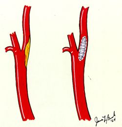 Endarterectomy -- Carotid Endarterectomy