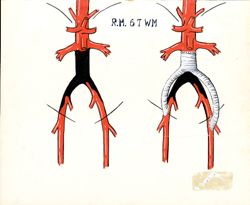 Bypass -- Replacement Graft above Aortic Bifurcation with Graft to Both Iliac Arteries