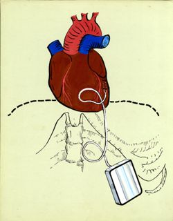 Other Procedures -- Pacemaker and Heart